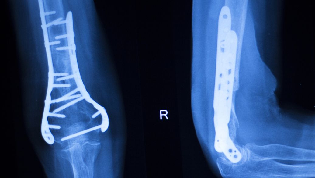 微创技术结合祖传中药治疗骨折；骨折7-10天可以下地行走。治愈快！费用少！！痛苦小！！！